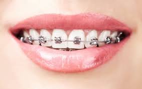 orthodontie par bagues en céramique